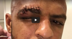 Terribile infortunio per Melo: taglio profondo e 13 punti di sutura! [VIDEO]